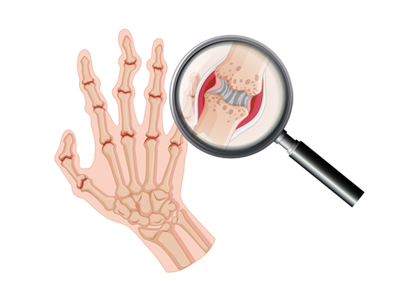 Rheumatoid Arthritis