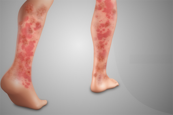 Systemic Vasculitis