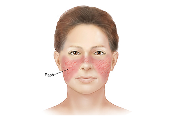 Systemic Lupus Erythematosus