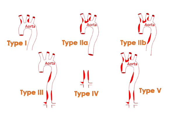 Takayasus Arteritis