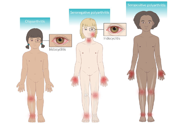 Juvenile Idiopathic Arthritis