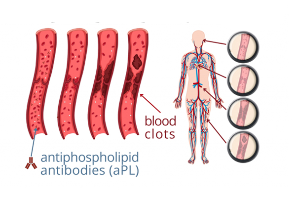 Antiphospholipid Antibody Syndrome APS